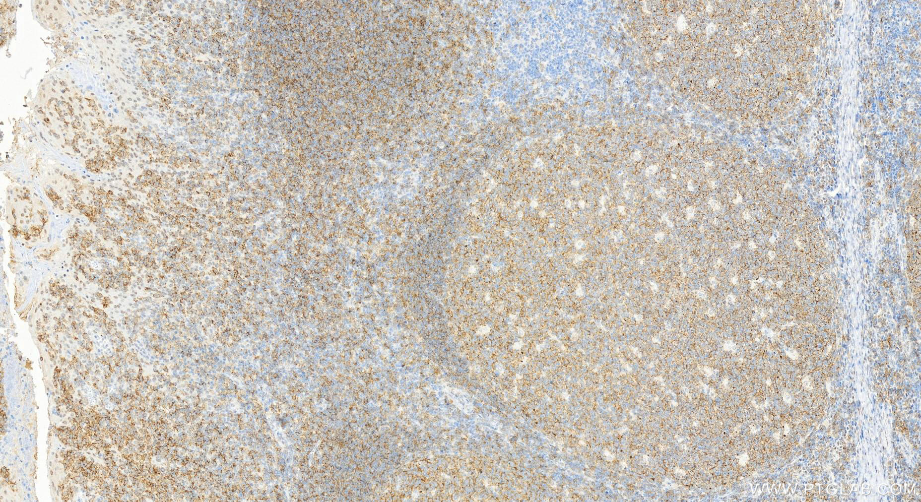 Immunohistochemistry (IHC) staining of human tonsillitis tissue using CD19 Monoclonal antibody (66298-1-Ig)