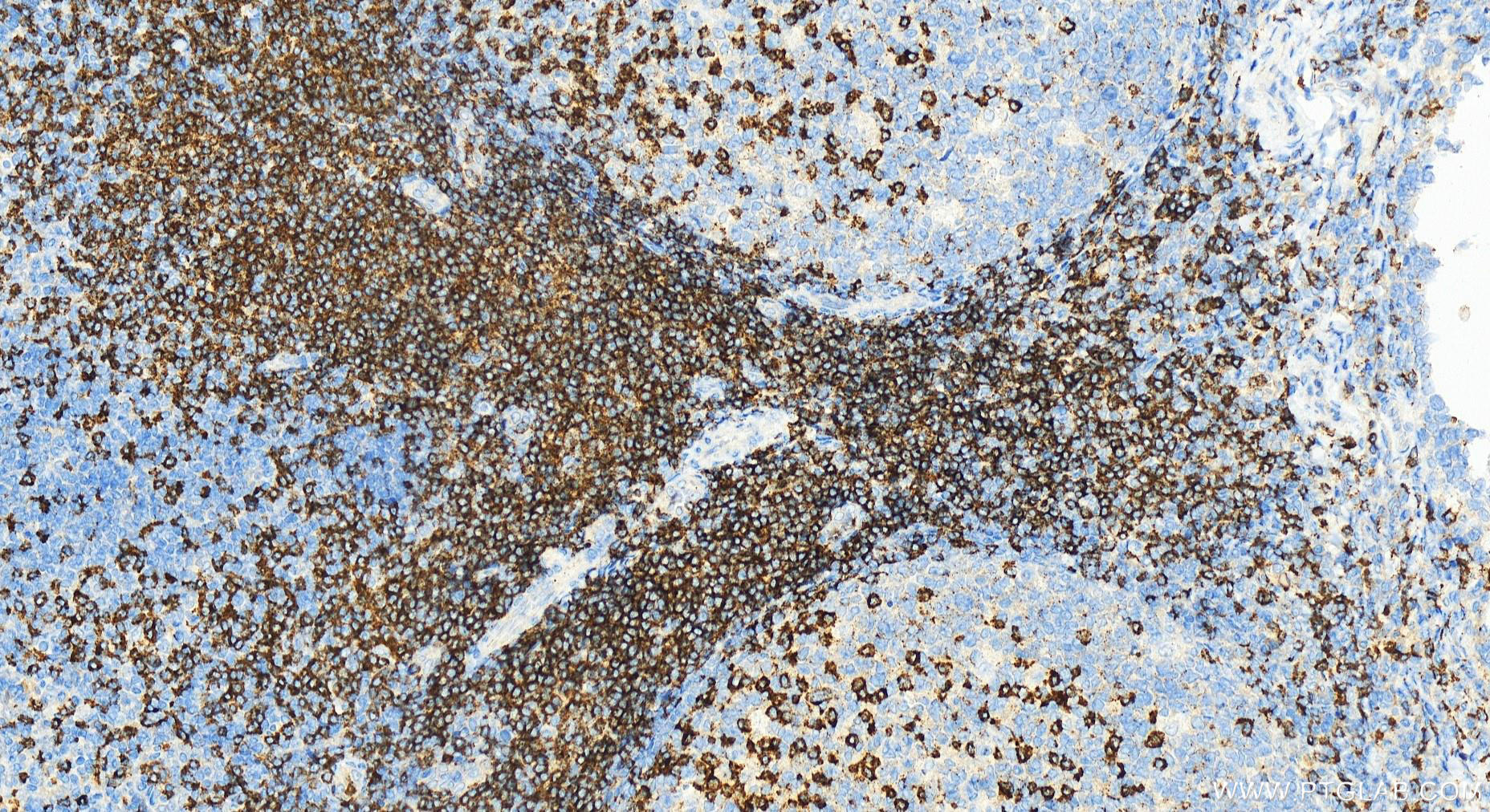 Immunohistochemistry (IHC) staining of human tonsillitis tissue using CD2 Polyclonal antibody (31803-1-AP)