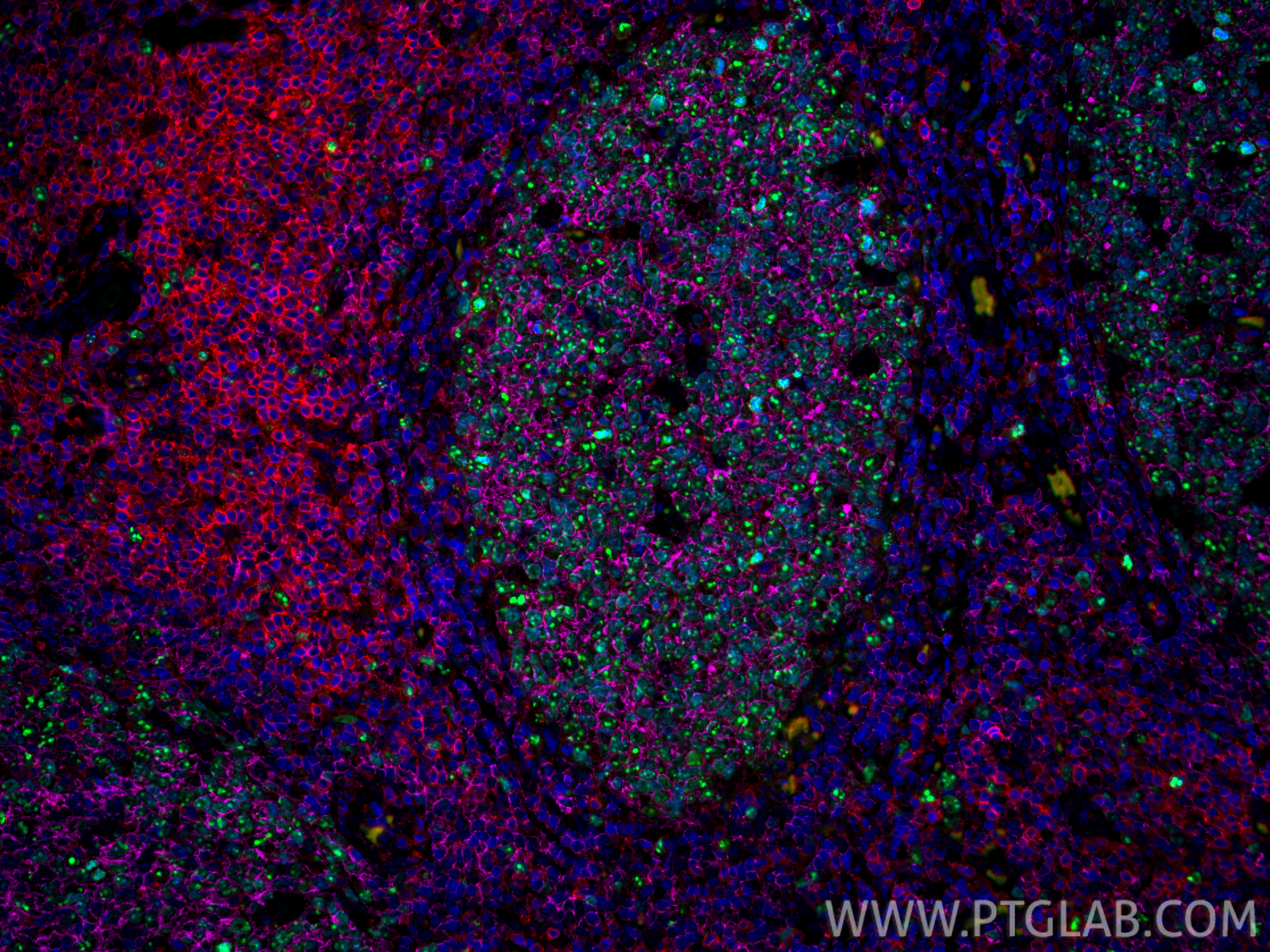 Immunofluorescence (IF) / fluorescent staining of human tonsillitis tissue using CoraLite® Plus 647-conjugated CD20 Monoclonal anti (CL647-60271)