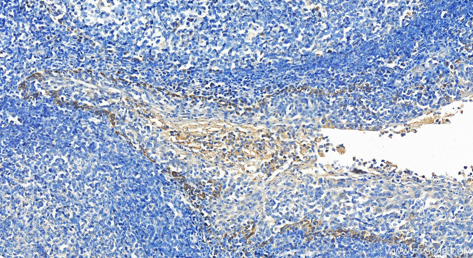 Immunohistochemistry (IHC) staining of human tonsillitis tissue using CD200 Polyclonal antibody (14057-1-AP)