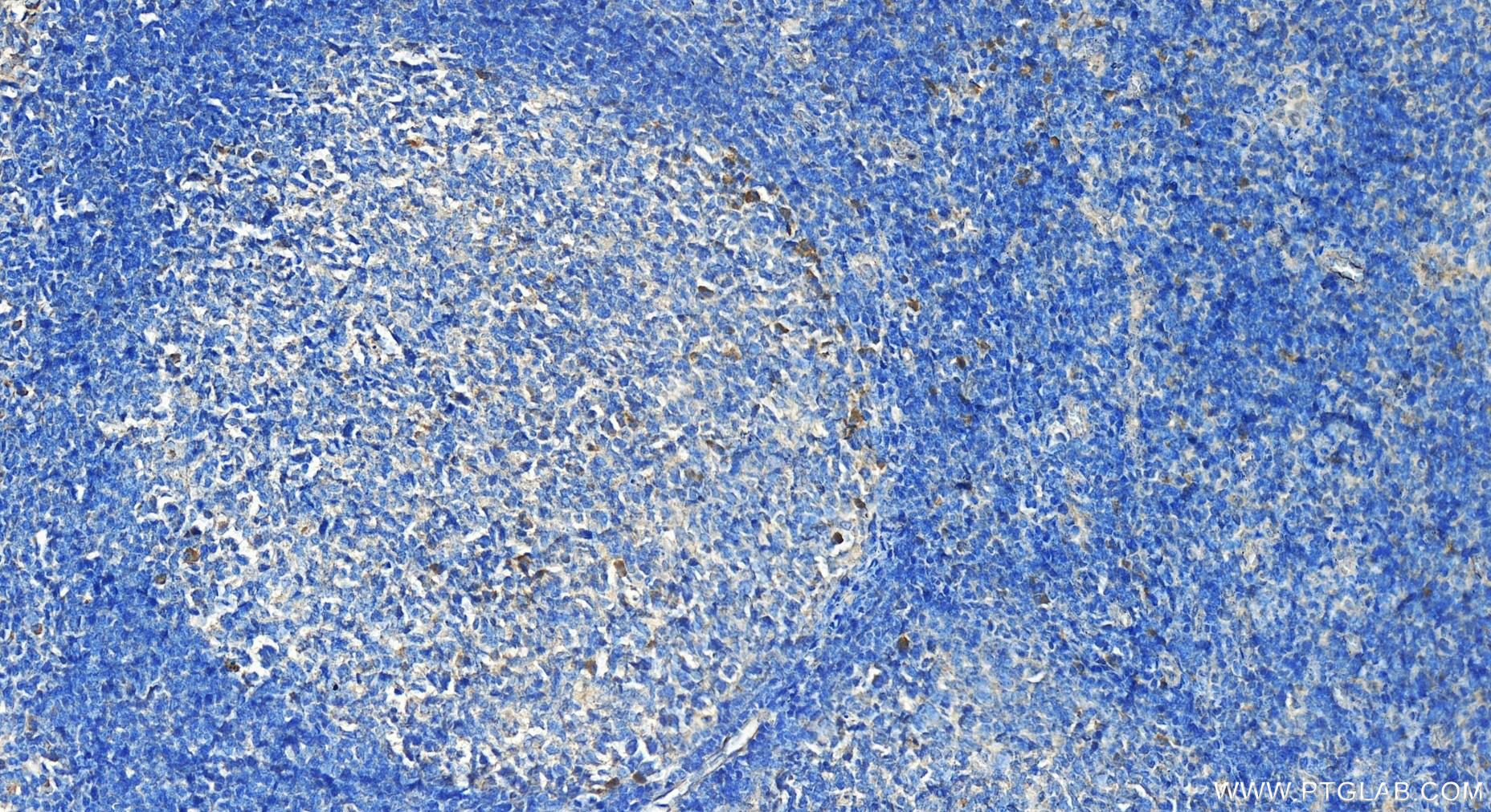 Immunohistochemistry (IHC) staining of human tonsillitis tissue using CD200 Polyclonal antibody (14057-1-AP)