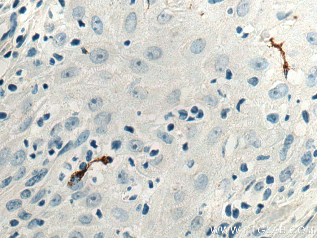 Immunohistochemistry (IHC) staining of human skin cancer tissue using CD207 Monoclonal antibody (67788-1-Ig)