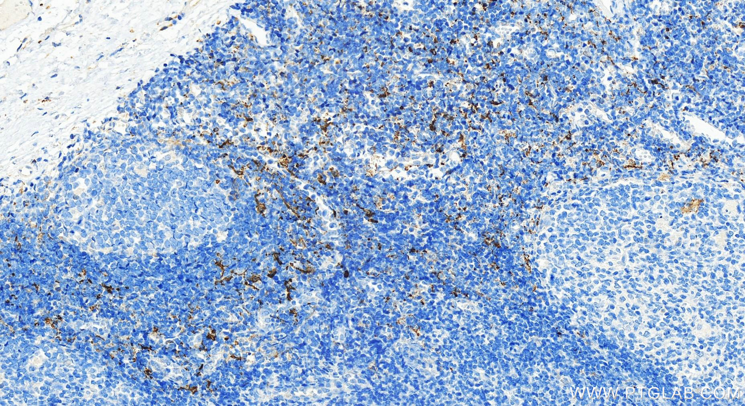 Immunohistochemistry (IHC) staining of human tonsillitis tissue using CD209 Polyclonal antibody (31621-1-AP)