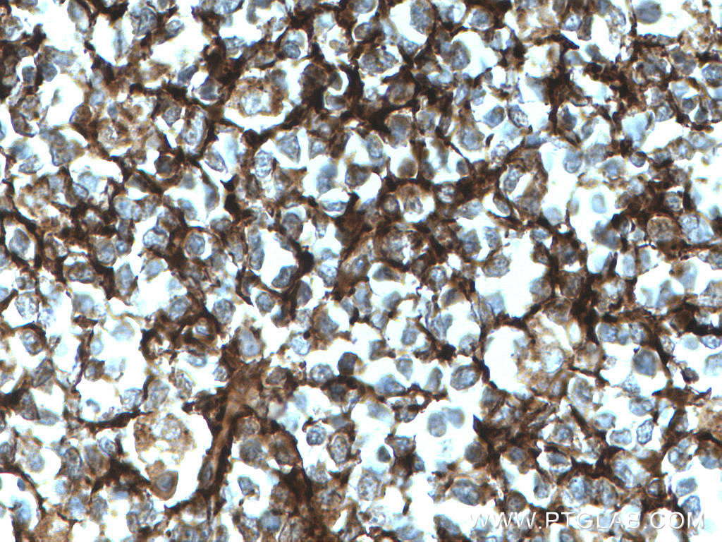 Immunohistochemistry (IHC) staining of human tonsillitis tissue using CD21 Polyclonal antibody (28206-1-AP)