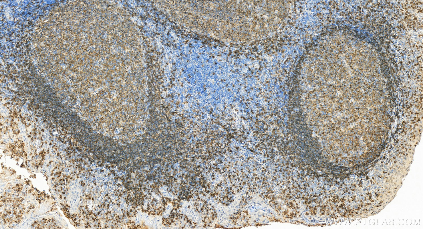 Immunohistochemistry (IHC) staining of human tonsillitis tissue using CD22 Polyclonal antibody (30954-1-AP)