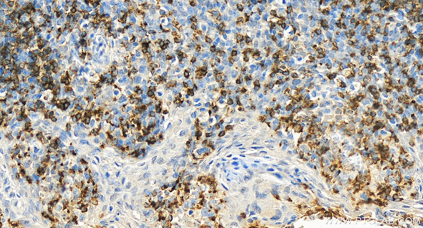 Immunohistochemistry (IHC) staining of human tonsillitis tissue using CD22 Polyclonal antibody (30954-1-AP)