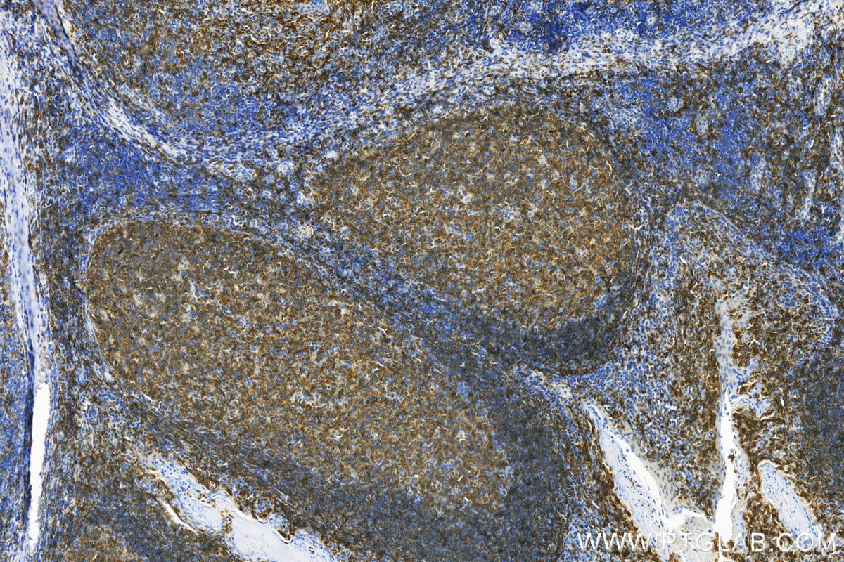 Immunohistochemistry (IHC) staining of human tonsillitis tissue using CD22 Polyclonal antibody (30954-1-AP)