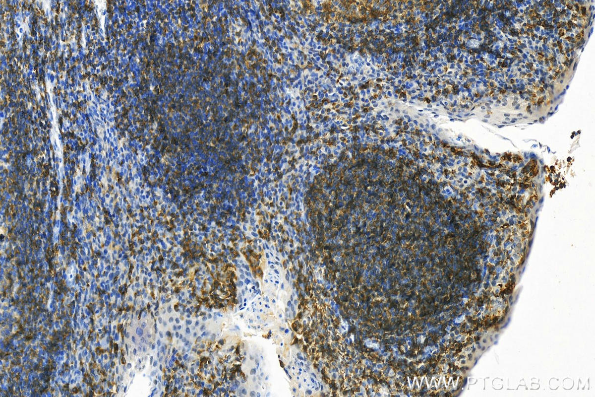 Immunohistochemistry (IHC) staining of human tonsillitis tissue using CD22 Polyclonal antibody (30954-1-AP)