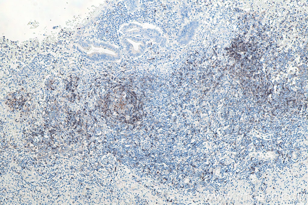 Immunohistochemistry (IHC) staining of human appendicitis tissue using CD22 Monoclonal antibody (66103-1-Ig)