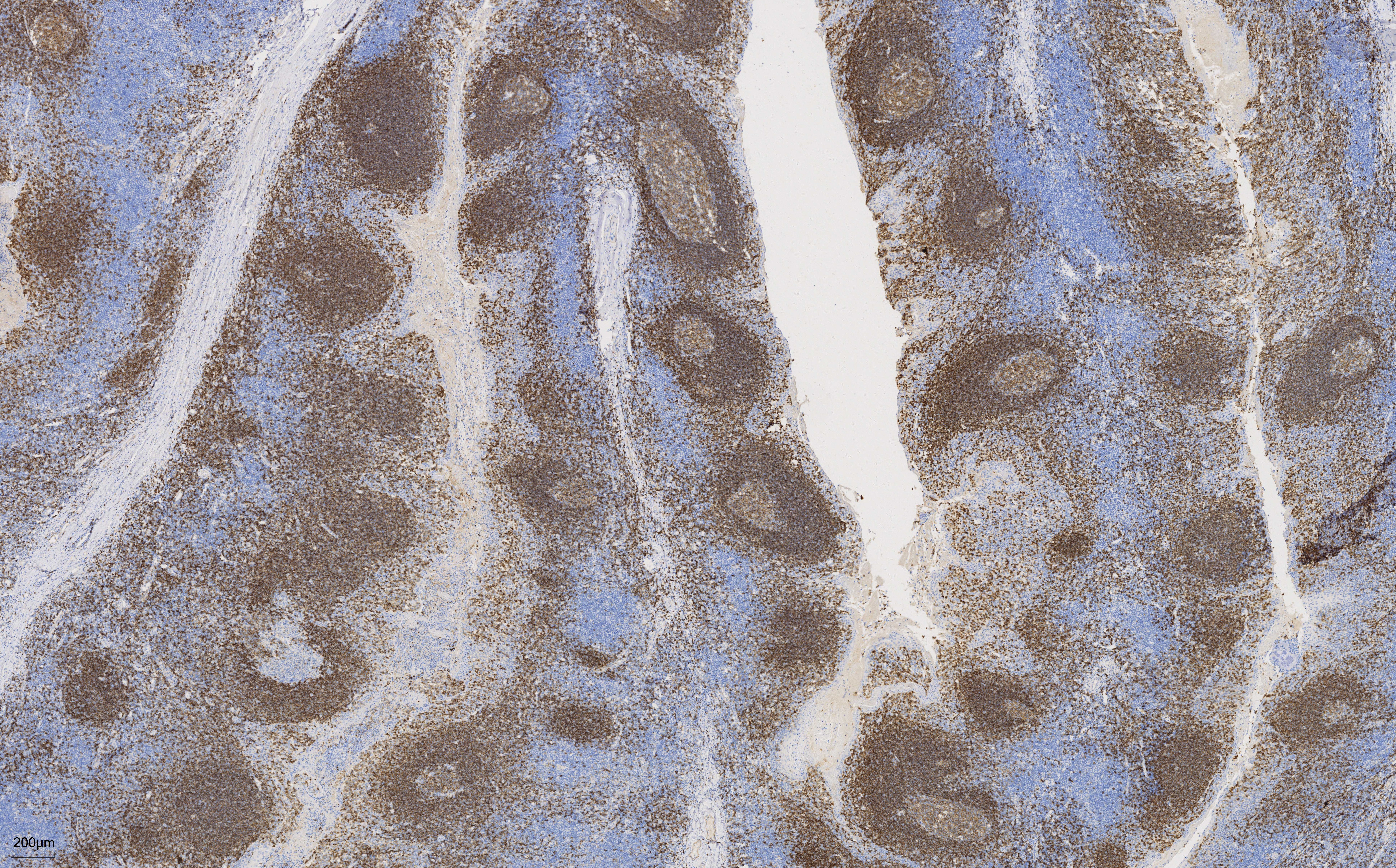 Immunohistochemistry (IHC) staining of human tonsillitis tissue using CD22 Monoclonal antibody (66103-1-Ig)