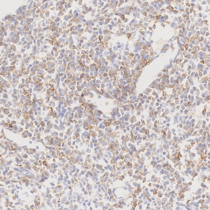 Immunohistochemistry (IHC) staining of human lymphoma tissue using CD22 Monoclonal antibody (66103-1-Ig)