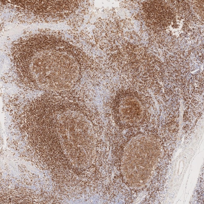 Immunohistochemistry (IHC) staining of human tonsillitis tissue using CD22 Monoclonal antibody (66103-1-Ig)