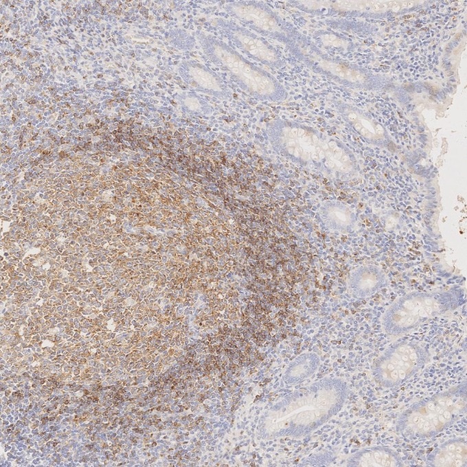 Immunohistochemistry (IHC) staining of human appendicitis tissue using CD22 Monoclonal antibody (66103-1-Ig)