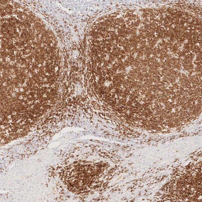Immunohistochemistry (IHC) staining of human lymphoma tissue using CD22 Monoclonal antibody (66103-1-Ig)