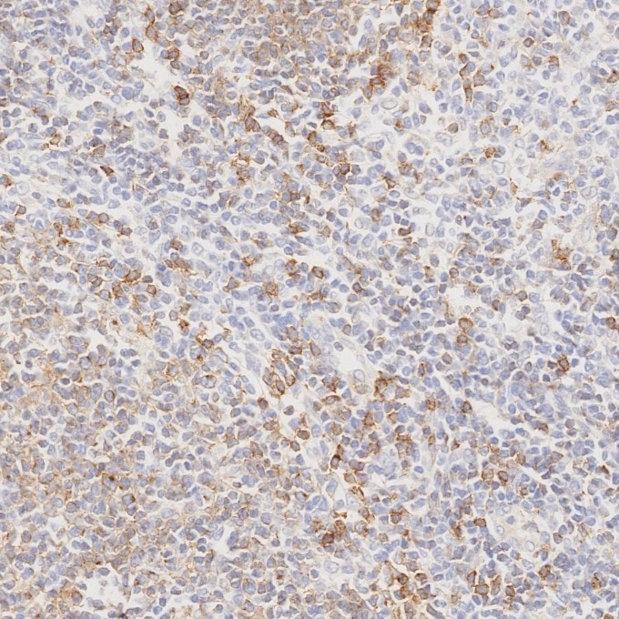 Immunohistochemistry (IHC) staining of human lymphoma tissue using CD22 Monoclonal antibody (66103-1-Ig)