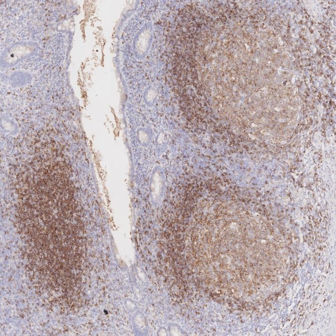 Immunohistochemistry (IHC) staining of human appendicitis tissue using CD22 Monoclonal antibody (66103-1-Ig)