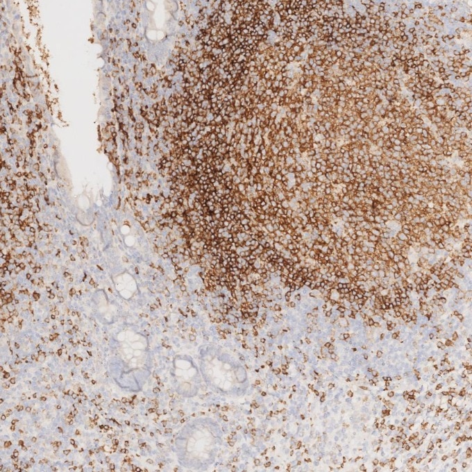 Immunohistochemistry (IHC) staining of human appendicitis tissue using CD22 Monoclonal antibody (66103-1-Ig)