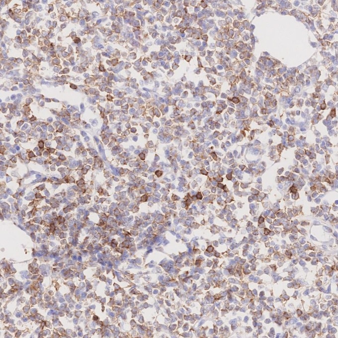 Immunohistochemistry (IHC) staining of human lymphoma tissue using CD22 Monoclonal antibody (66103-1-Ig)