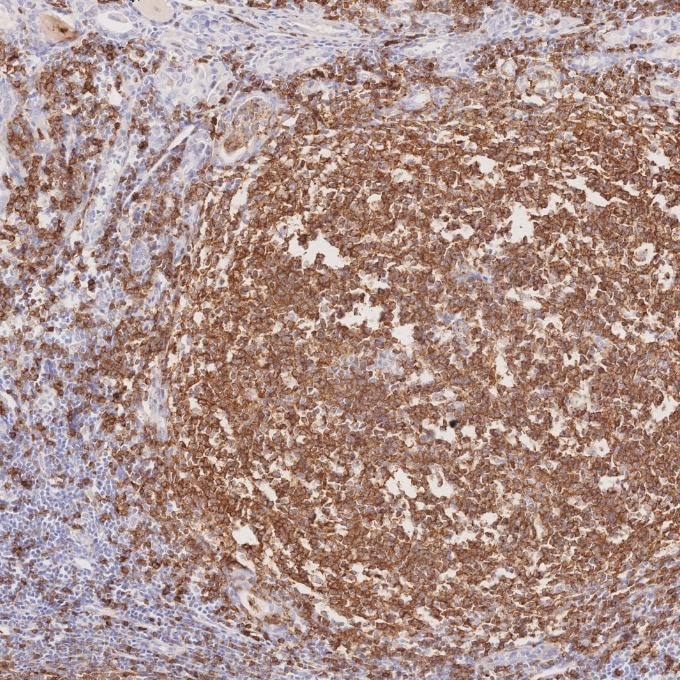 Immunohistochemistry (IHC) staining of human lymphoma tissue using CD22 Monoclonal antibody (66103-1-Ig)