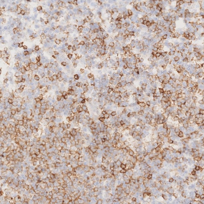 Immunohistochemistry (IHC) staining of human lymphoma tissue using CD22 Monoclonal antibody (66103-1-Ig)