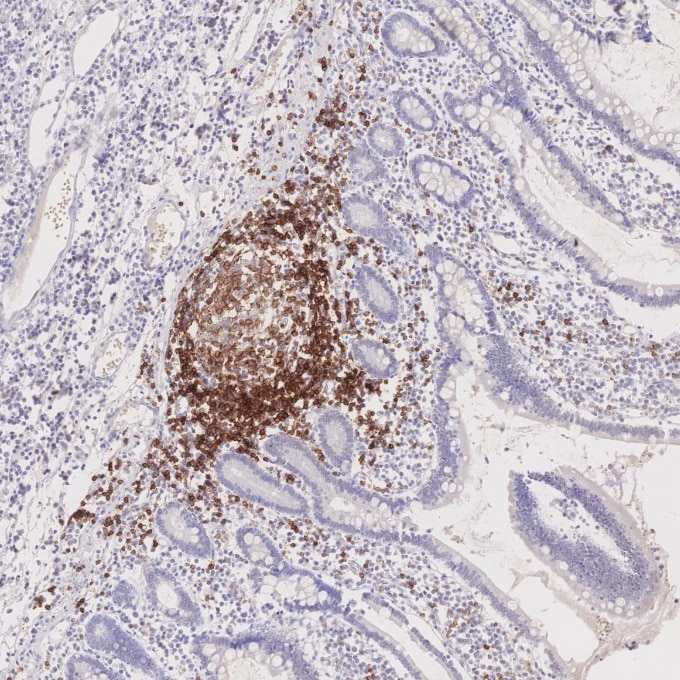 Immunohistochemistry (IHC) staining of human lymphoma tissue using CD22 Monoclonal antibody (66103-1-Ig)