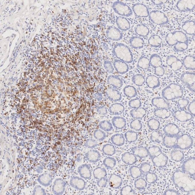 Immunohistochemistry (IHC) staining of human lymphoma tissue using CD22 Monoclonal antibody (66103-1-Ig)