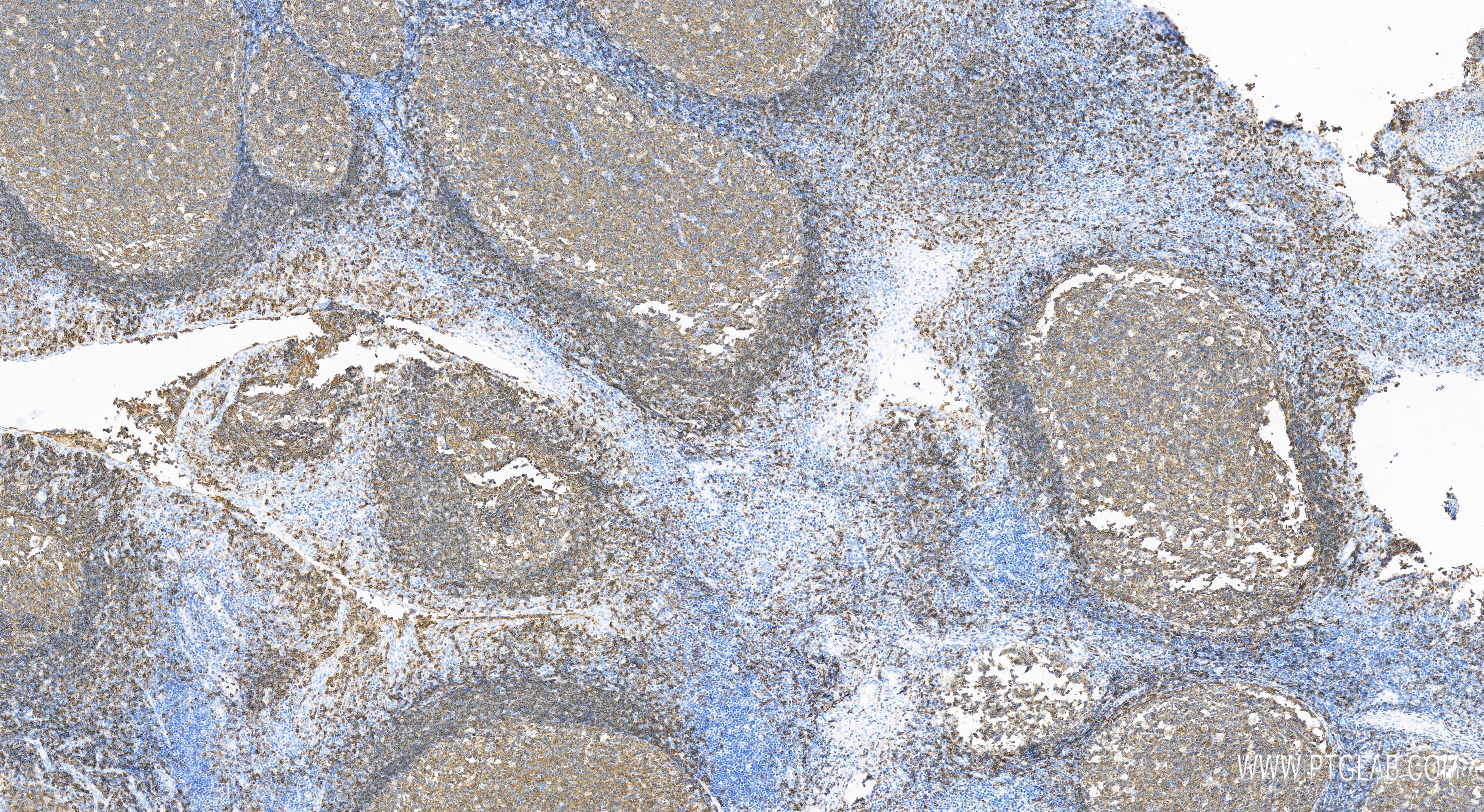 Immunohistochemistry (IHC) staining of human tonsillitis tissue using CD22 Recombinant antibody (83303-1-RR)