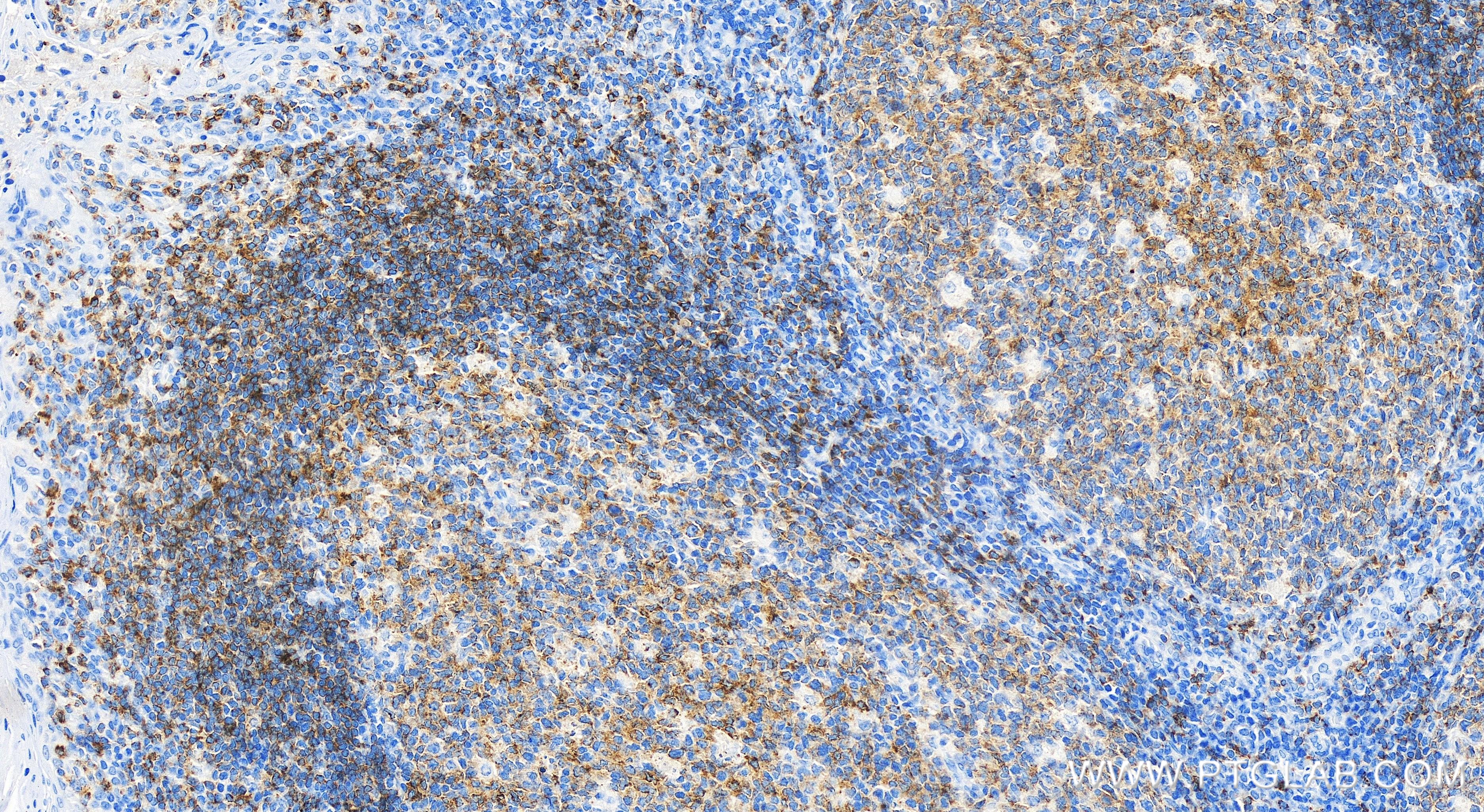 Immunohistochemistry (IHC) staining of human tonsillitis tissue using CD22 Recombinant antibody (84265-5-RR)