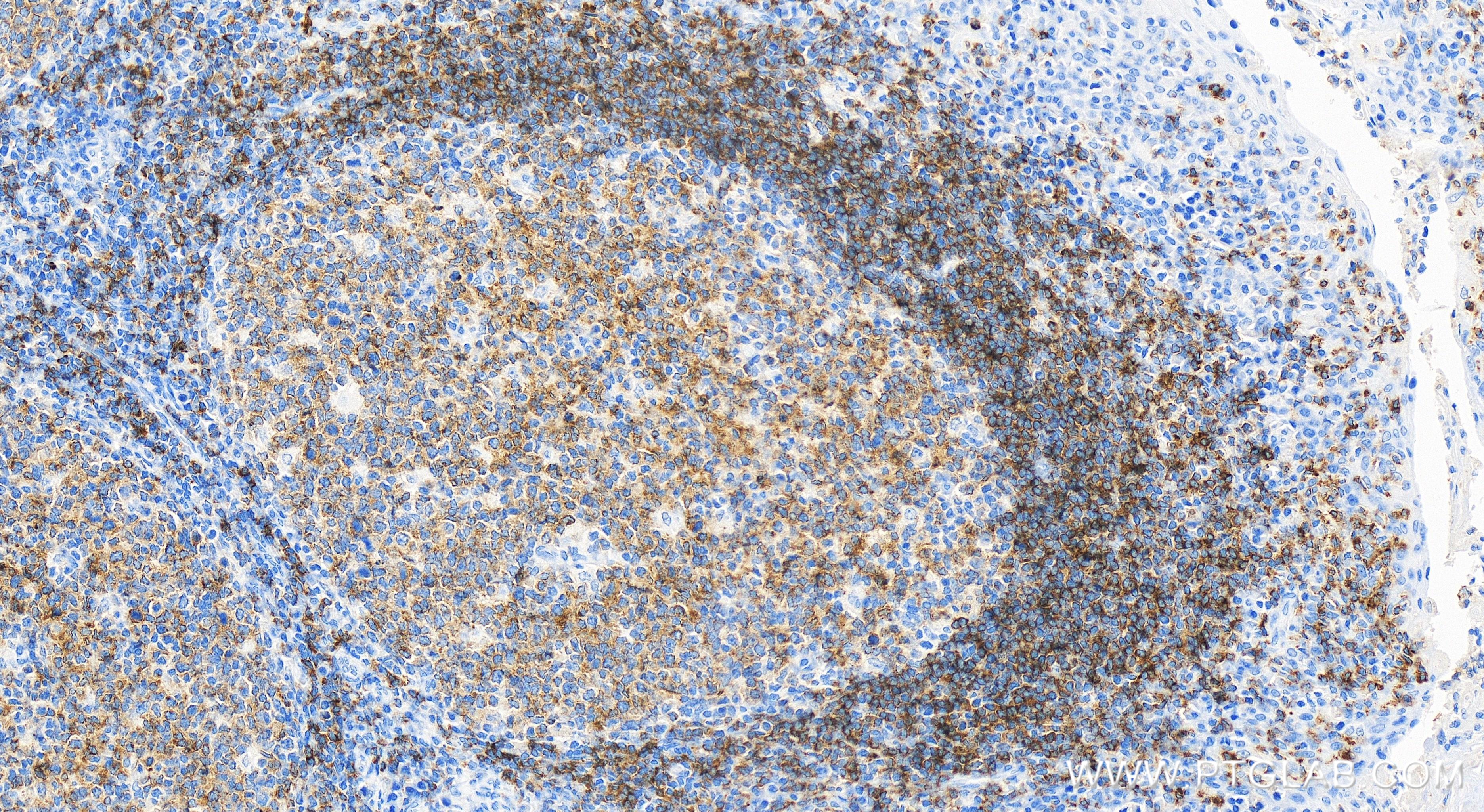 Immunohistochemistry (IHC) staining of human tonsillitis tissue using CD22 Recombinant antibody (84265-5-RR)