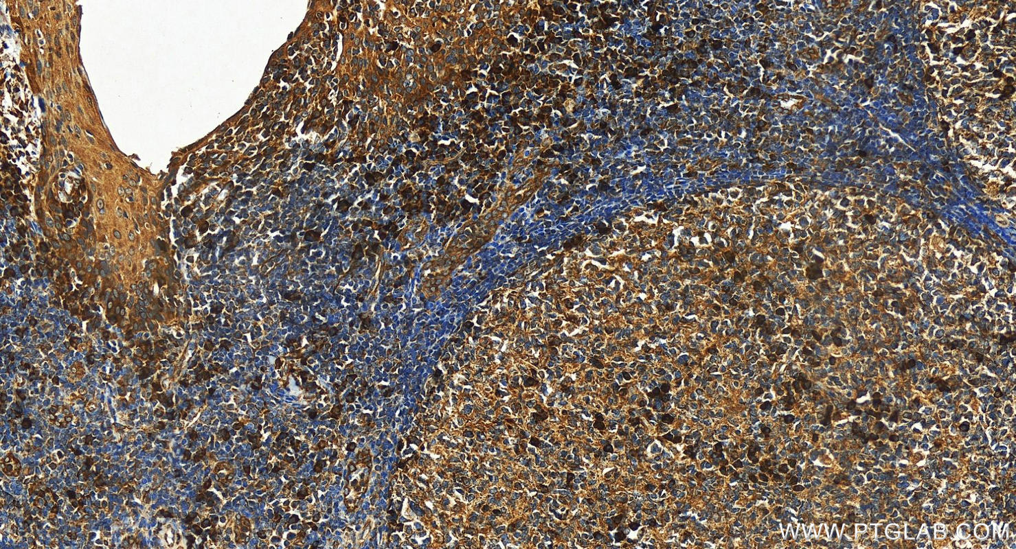 Immunohistochemistry (IHC) staining of human tonsillitis tissue using CD226 Polyclonal antibody (17842-1-AP)