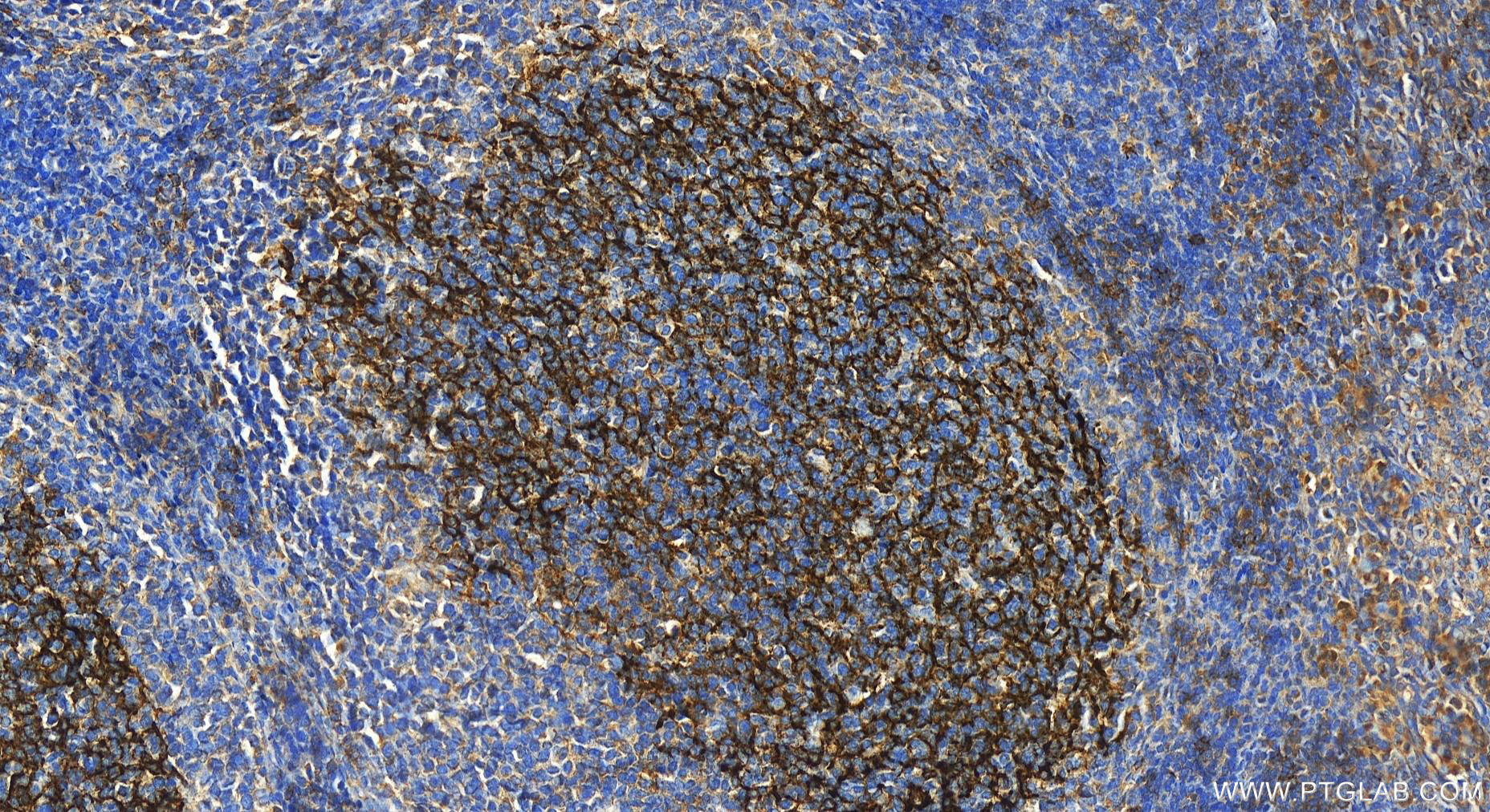 Immunohistochemistry (IHC) staining of human tonsillitis tissue using CD23 Monoclonal antibody (60208-1-Ig)