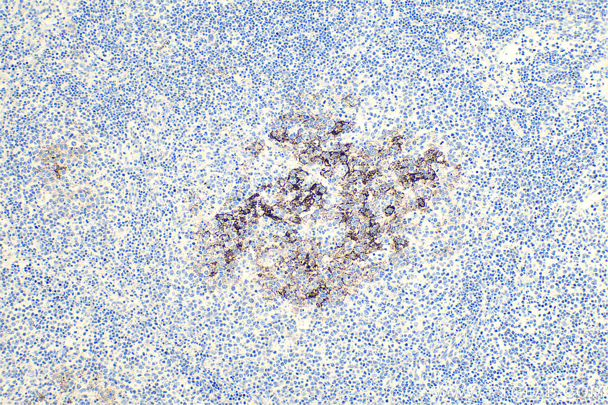 Immunohistochemistry (IHC) staining of human lymphoma tissue using CD23 Monoclonal antibody (60208-2-Ig)