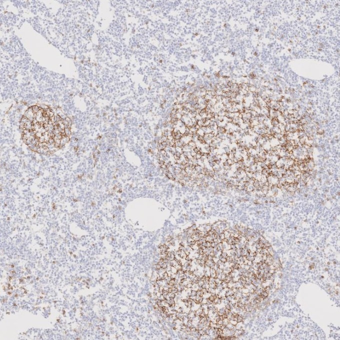 Immunohistochemistry (IHC) staining of human lymphoma tissue using CD23 Monoclonal antibody (60208-2-Ig)