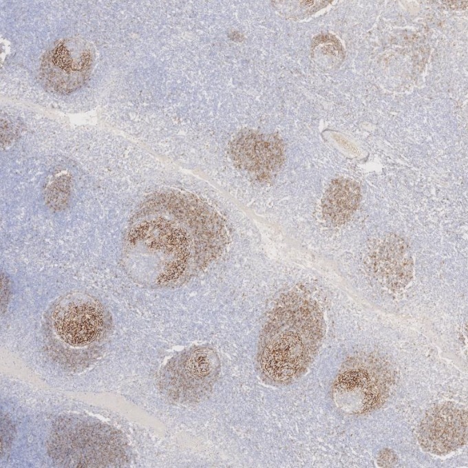 Immunohistochemistry (IHC) staining of human tonsillitis tissue using CD23 Monoclonal antibody (60208-2-Ig)