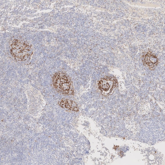 Immunohistochemistry (IHC) staining of human lymphoma tissue using CD23 Monoclonal antibody (60208-2-Ig)