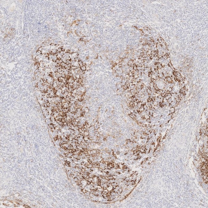 Immunohistochemistry (IHC) staining of human lymphoma tissue using CD23 Monoclonal antibody (60208-2-Ig)