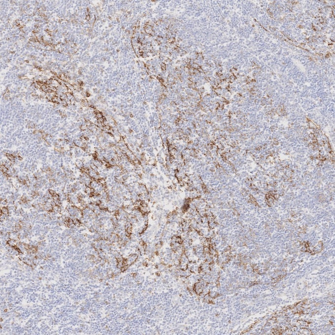 Immunohistochemistry (IHC) staining of human lymphoma tissue using CD23 Monoclonal antibody (60208-2-Ig)