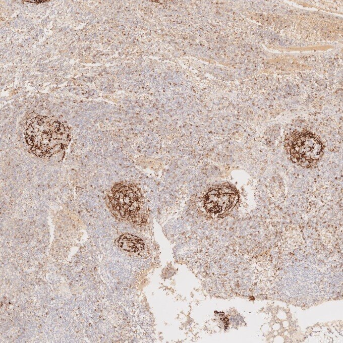 Immunohistochemistry (IHC) staining of human lymphoma tissue using CD23 Monoclonal antibody (60208-2-Ig)
