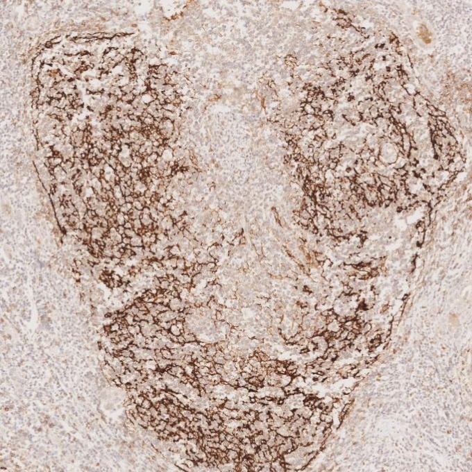 Immunohistochemistry (IHC) staining of human lymphoma tissue using CD23 Monoclonal antibody (60208-2-Ig)