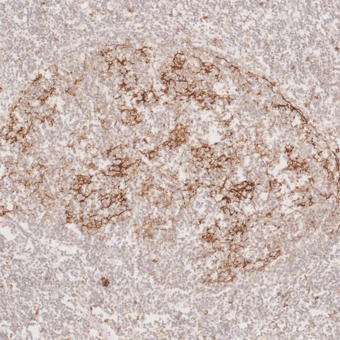 Immunohistochemistry (IHC) staining of human lymphoma tissue using CD23 Monoclonal antibody (60208-2-Ig)