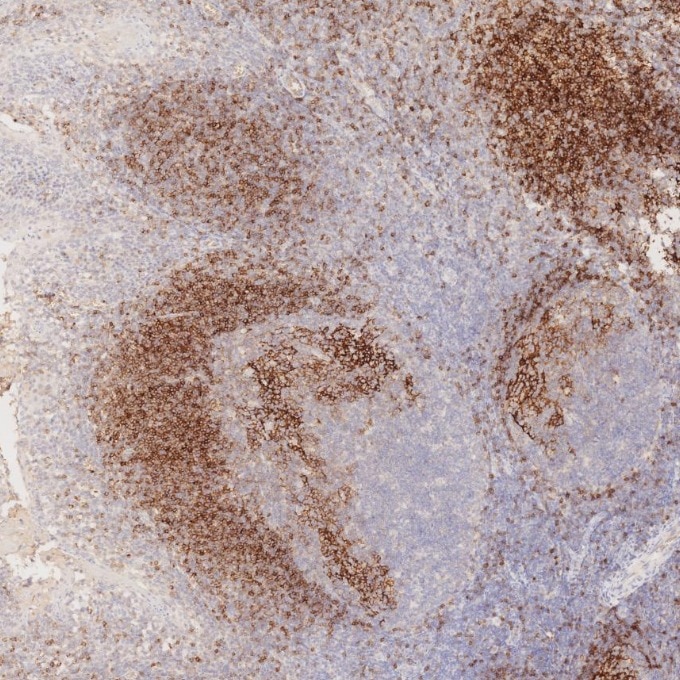 Immunohistochemistry (IHC) staining of human tonsillitis tissue using CD23 Monoclonal antibody (60208-2-Ig)