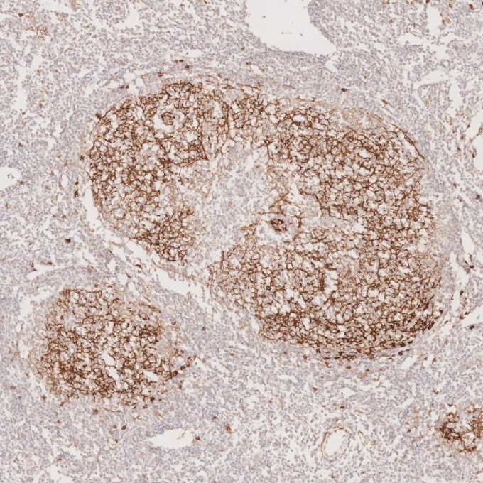 Immunohistochemistry (IHC) staining of human lymphoma tissue using CD23 Monoclonal antibody (60208-2-Ig)