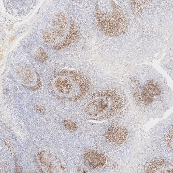 Immunohistochemistry (IHC) staining of human tonsillitis tissue using CD23 Monoclonal antibody (60208-2-Ig)