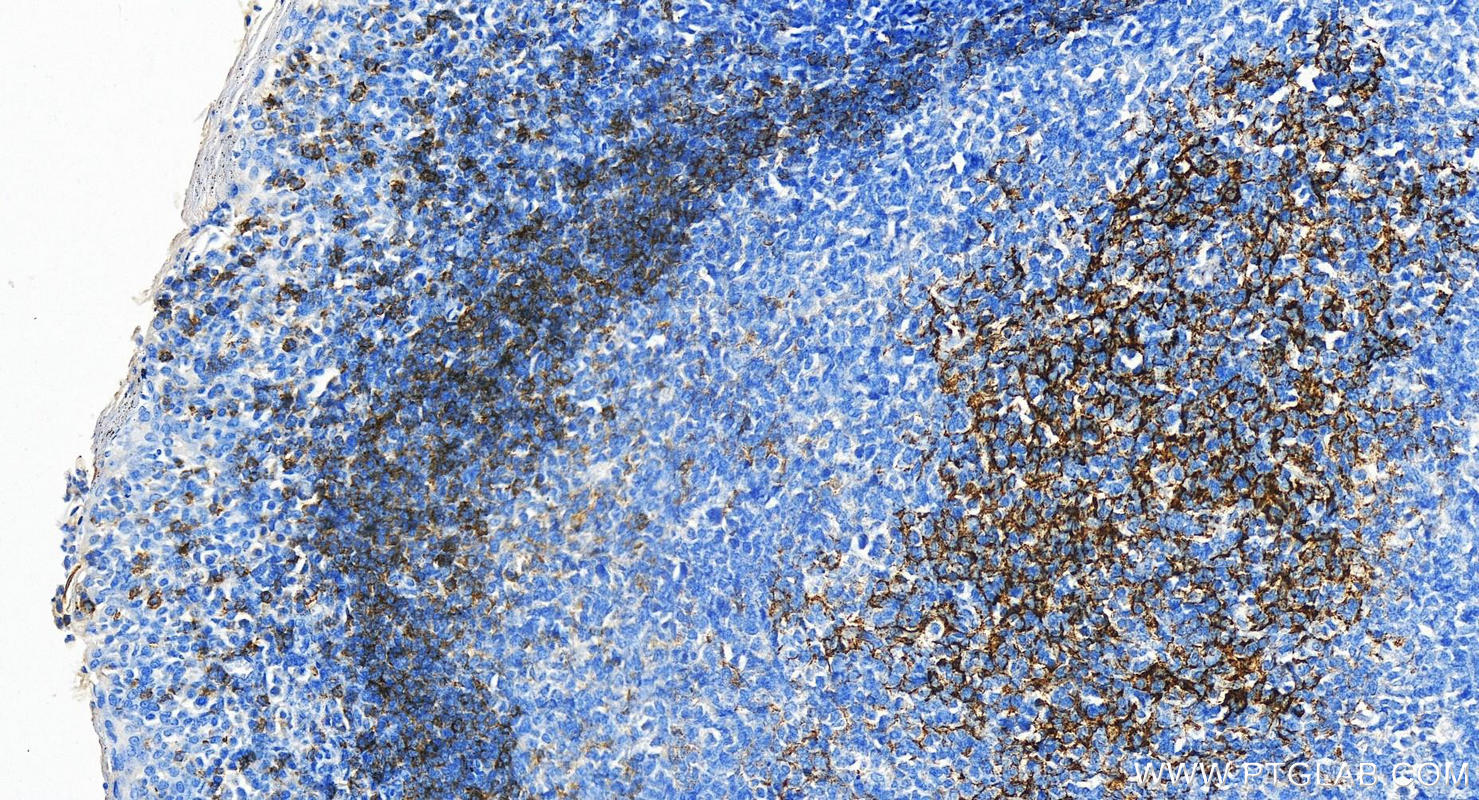 Immunohistochemistry (IHC) staining of human tonsillitis tissue using CD23 Polyclonal antibody (18642-1-AP)