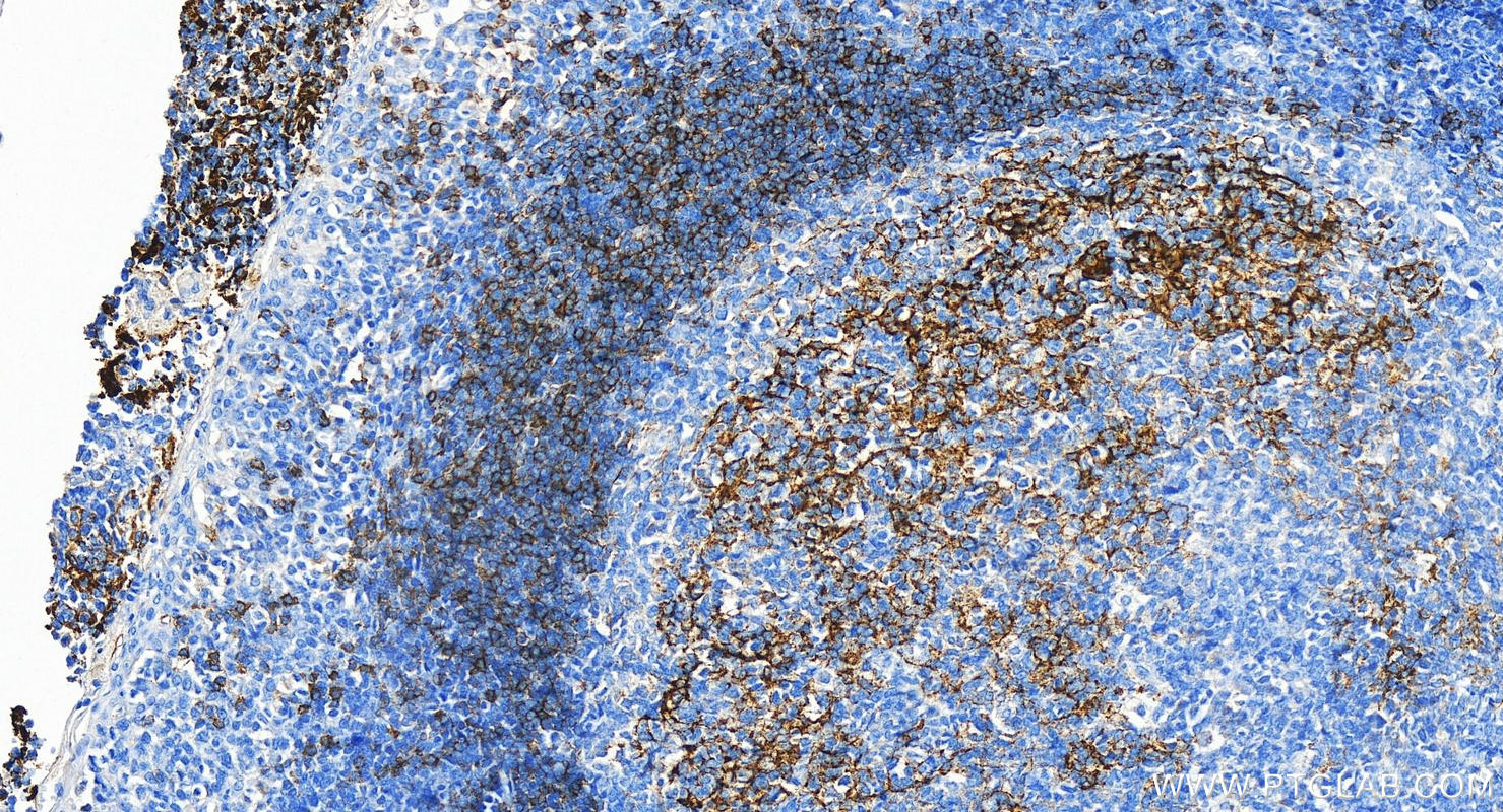 Immunohistochemistry (IHC) staining of human tonsillitis tissue using CD23 Polyclonal antibody (18642-1-AP)