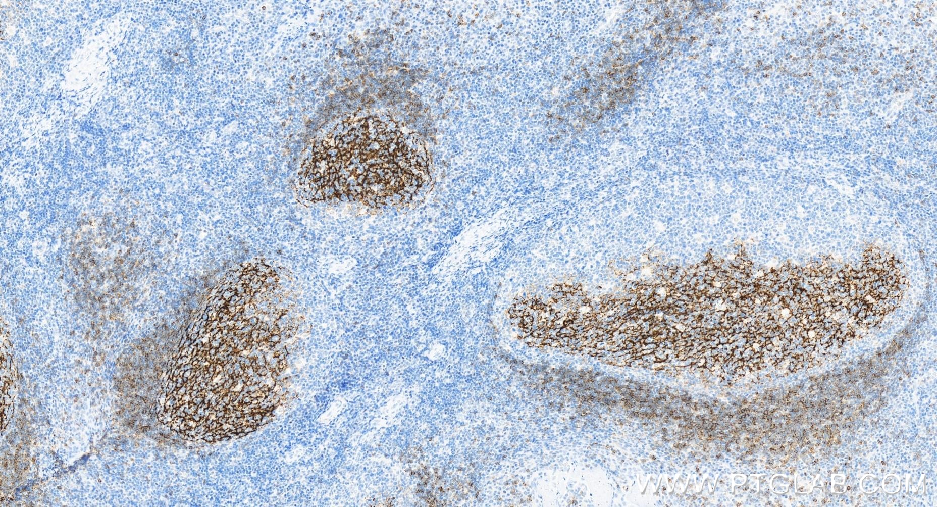 Immunohistochemistry (IHC) staining of human tonsillitis tissue using CD23 Recombinant antibody (84024-2-RR)