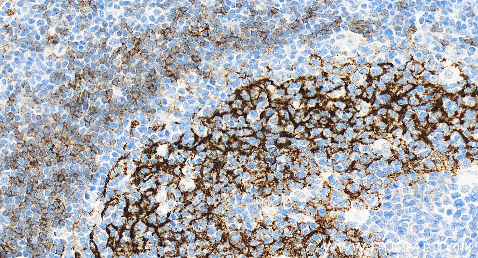 Immunohistochemistry (IHC) staining of human tonsillitis tissue using CD23 Recombinant antibody (84024-2-RR)