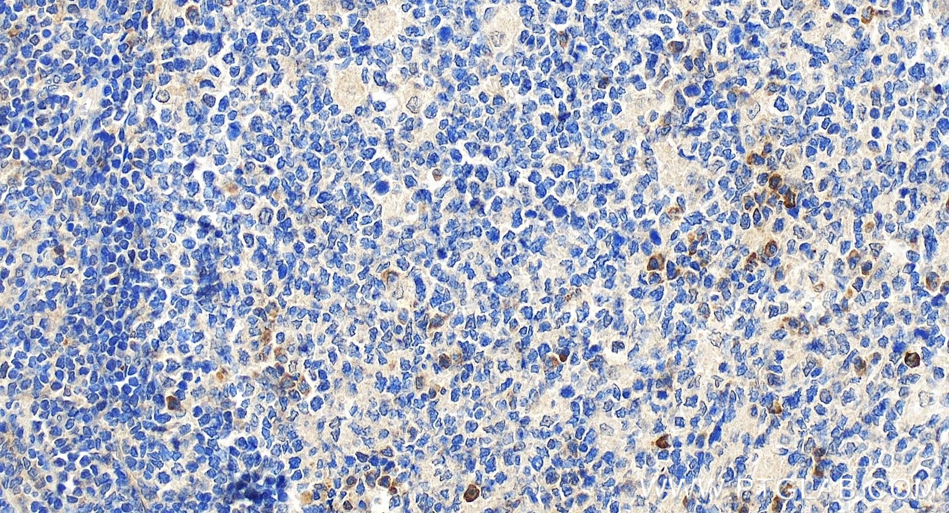 Immunohistochemistry (IHC) staining of human tonsillitis tissue using CD244 Recombinant antibody (84086-1-RR)