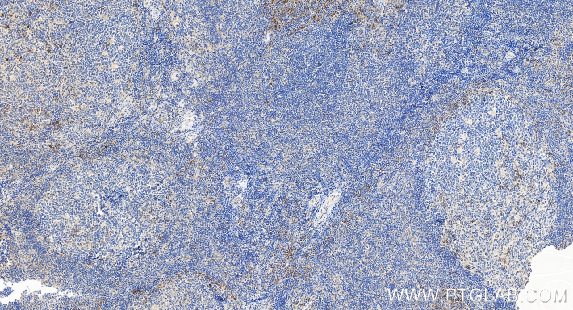 Immunohistochemistry (IHC) staining of human tonsillitis tissue using CD244 Recombinant antibody (84086-1-RR)