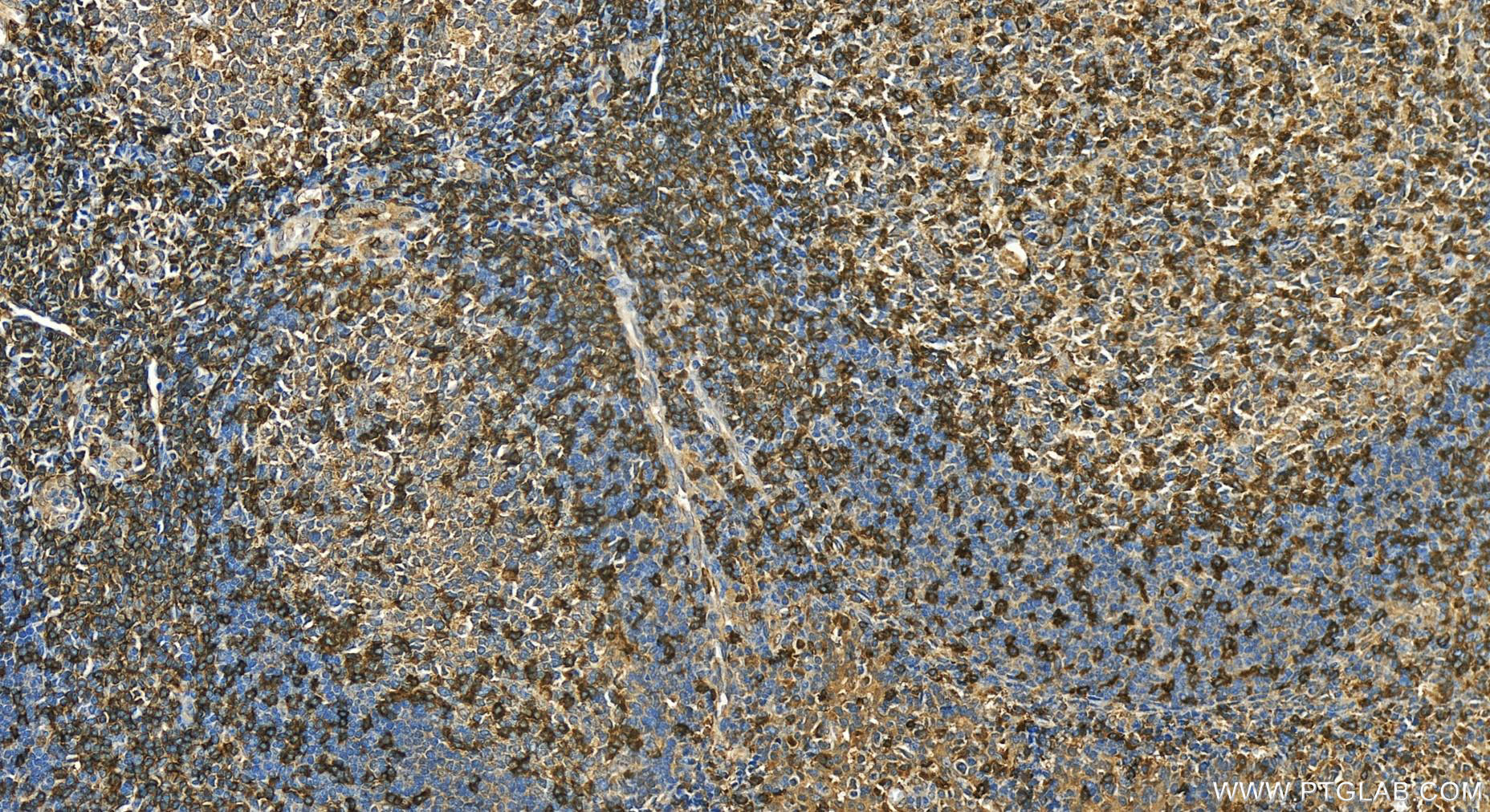 Immunohistochemistry (IHC) staining of human tonsillitis tissue using CD247 Polyclonal antibody (12837-2-AP)